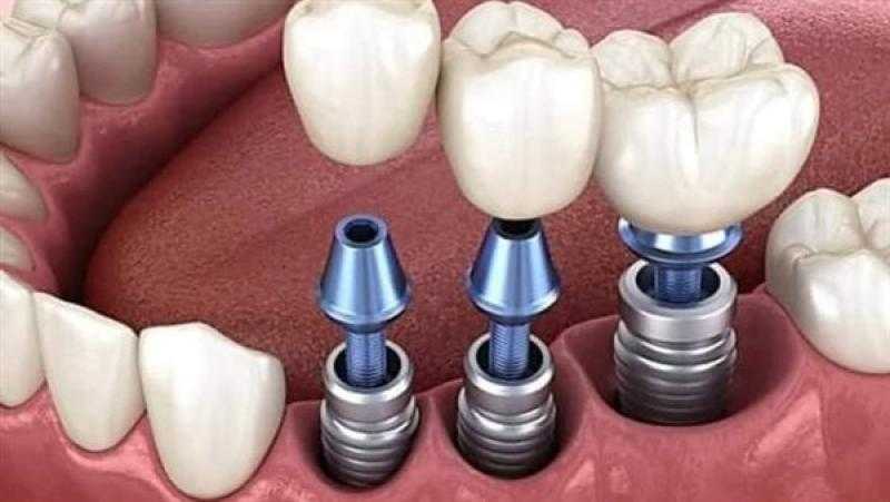 معلومات لا تعرفها عن عملية زرع الأسنان